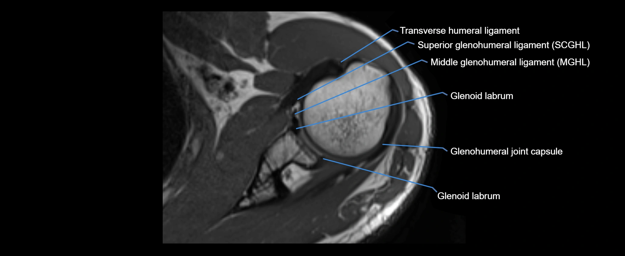 shoulder ligaments axial 3d 3t mri image-img-00005-00056.webp